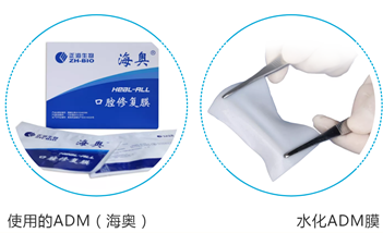 脱细胞真皮基质代替自体皮瓣修复口腔肿瘤术后缺损